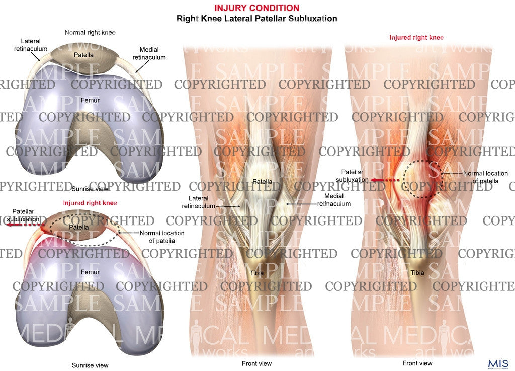 Right Knee Lateral Patellar Subluxation