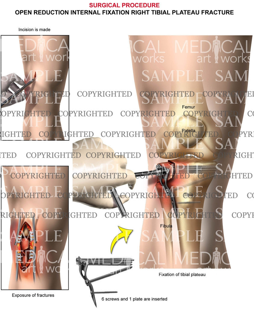 Left knee PCL tear