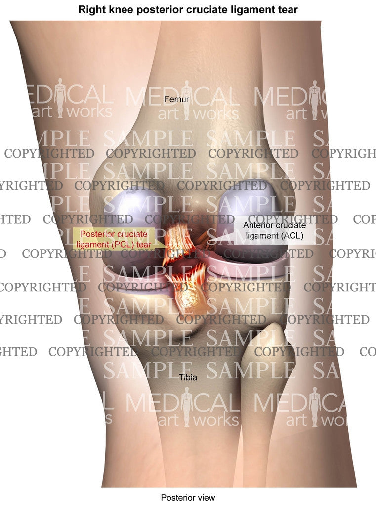 Right knee PCL tear