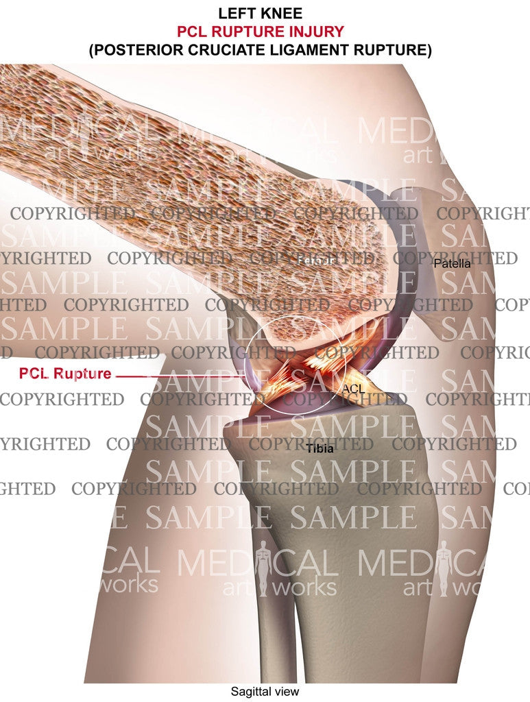 PCL tear of left knee