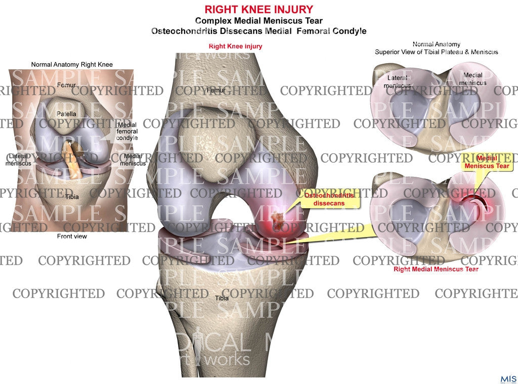 Right Knee Injury 2