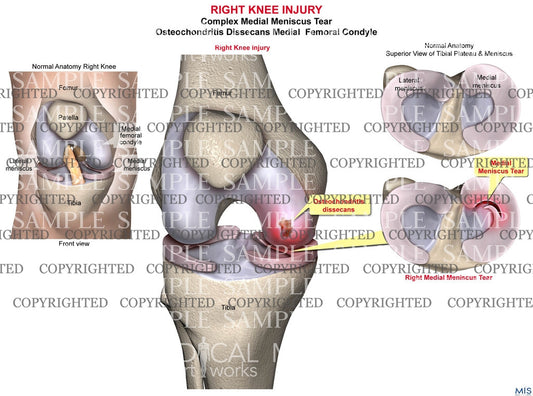 Right Knee Injury 2
