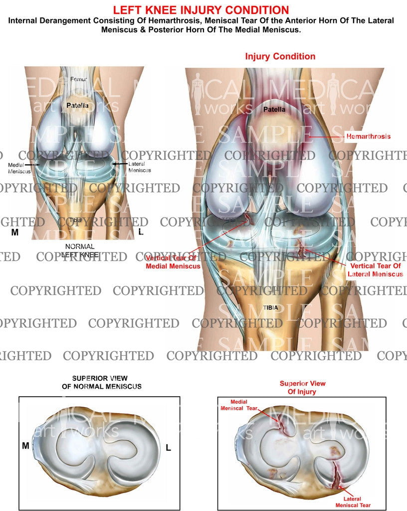 Left knee meniscal tears