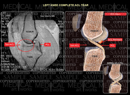 Left knee ACL complete tear - add your client's MRI