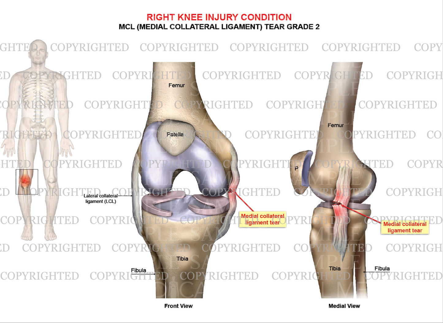 Right knee injury - MCL tear grade 2 - Male