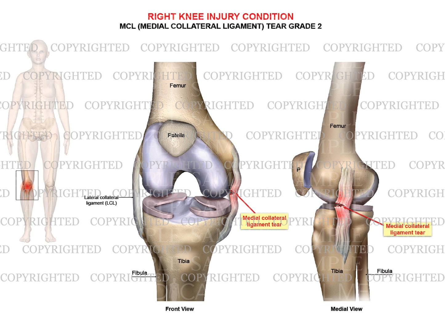 Right knee injury - MCL tear grade 2 - Female