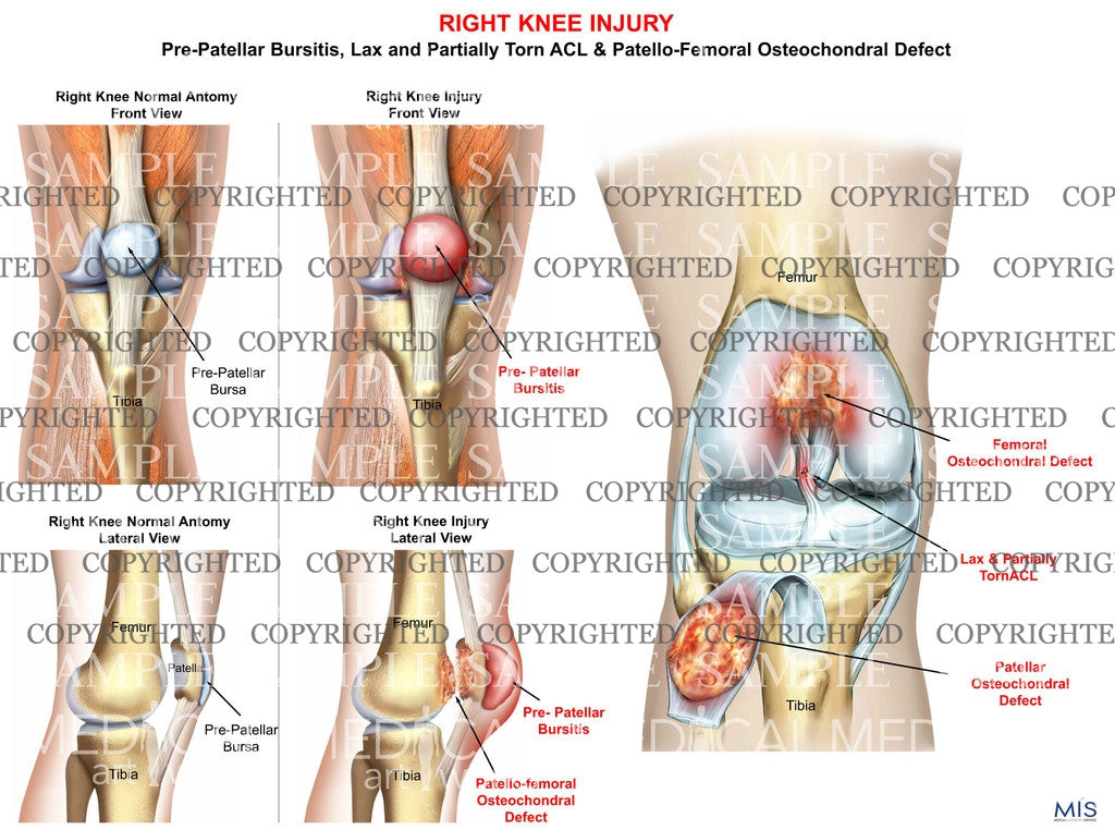 Right Knee Injury Pre-Patellar Bursitis and Patellofemoral Osteochondral Defect