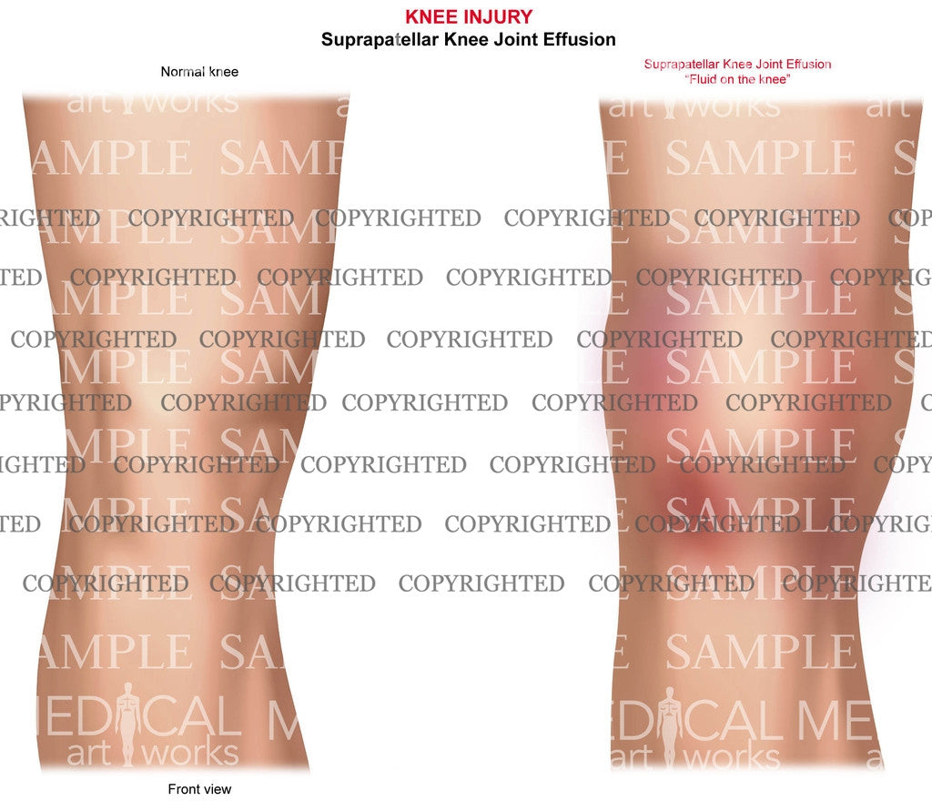 Suprapatellar Knee Joint Effusion