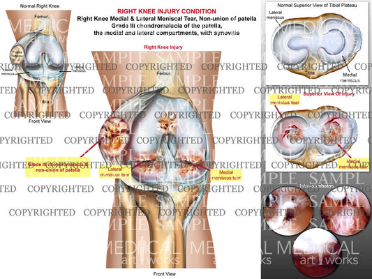 Right Knee Surgical Injury condition
