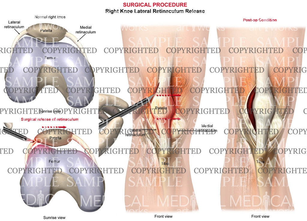 Right knee surgical procedure