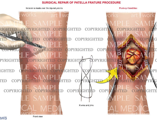 Right Knee patella frature procedure