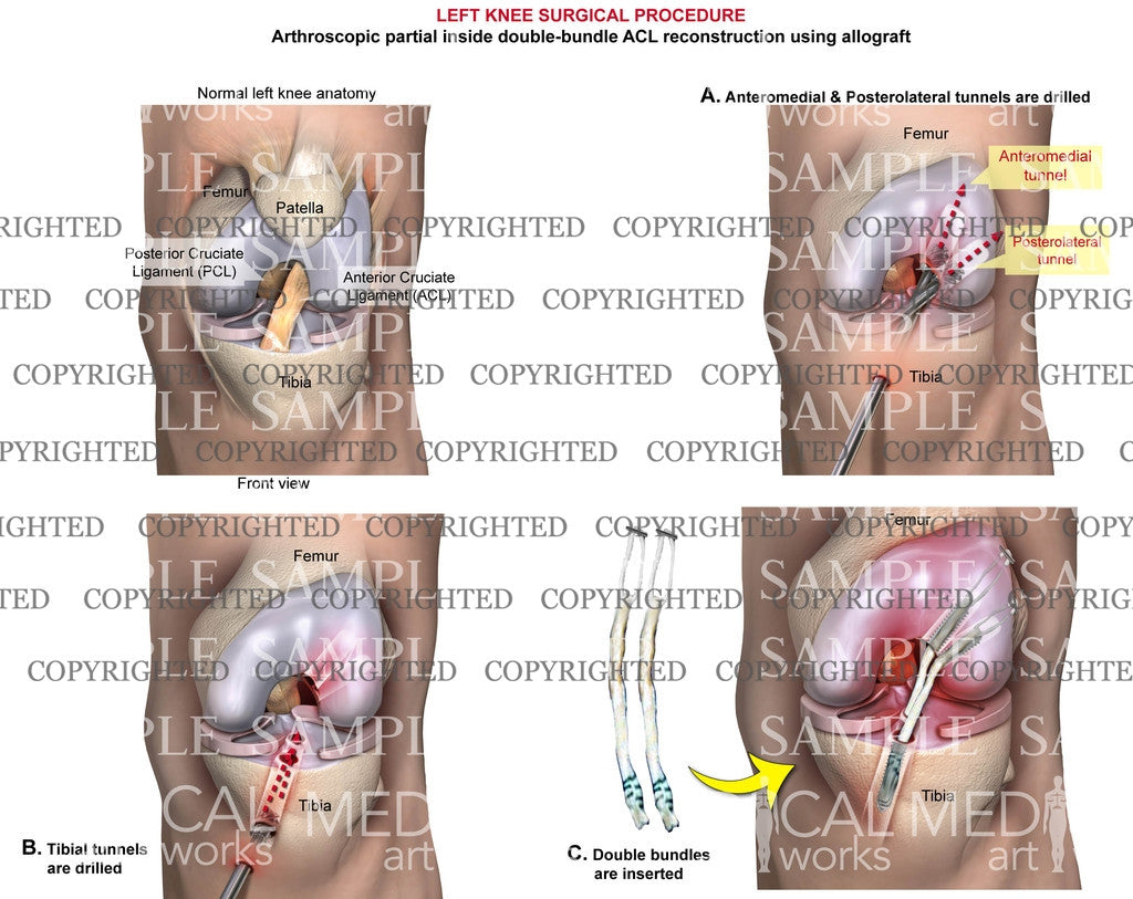 Surgical procedure of complete ACL rupture  with meniscus tear