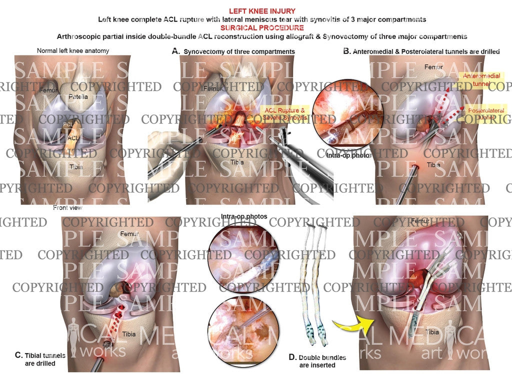 Surgical repair of complete ACL rupture