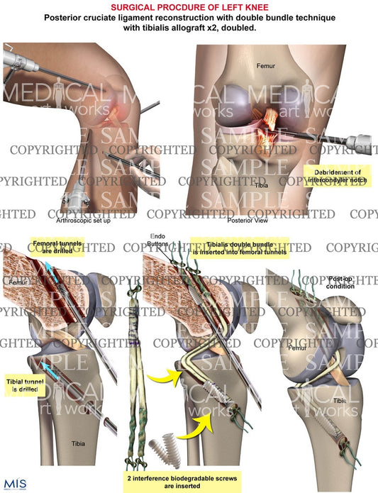 Surgical repair of posterior crutiate ligament tear