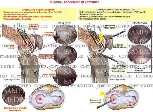 surgical procedure of left knee