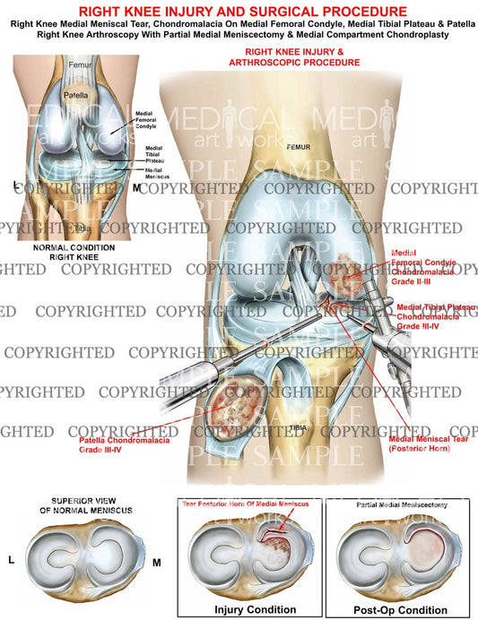 Right knee injury & arthroscopic surgical procedure - Meniscectomy - Chondroplasty