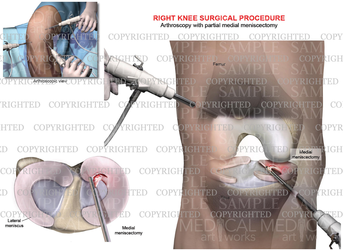 Arthroscopy of right knee with partial medial meniscectomy