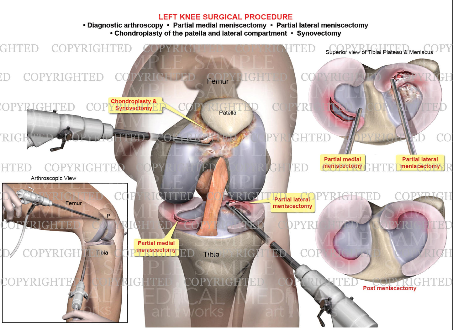Arthroscopic repair of left knee meniscal tears - Chondromalacia - Synovitis