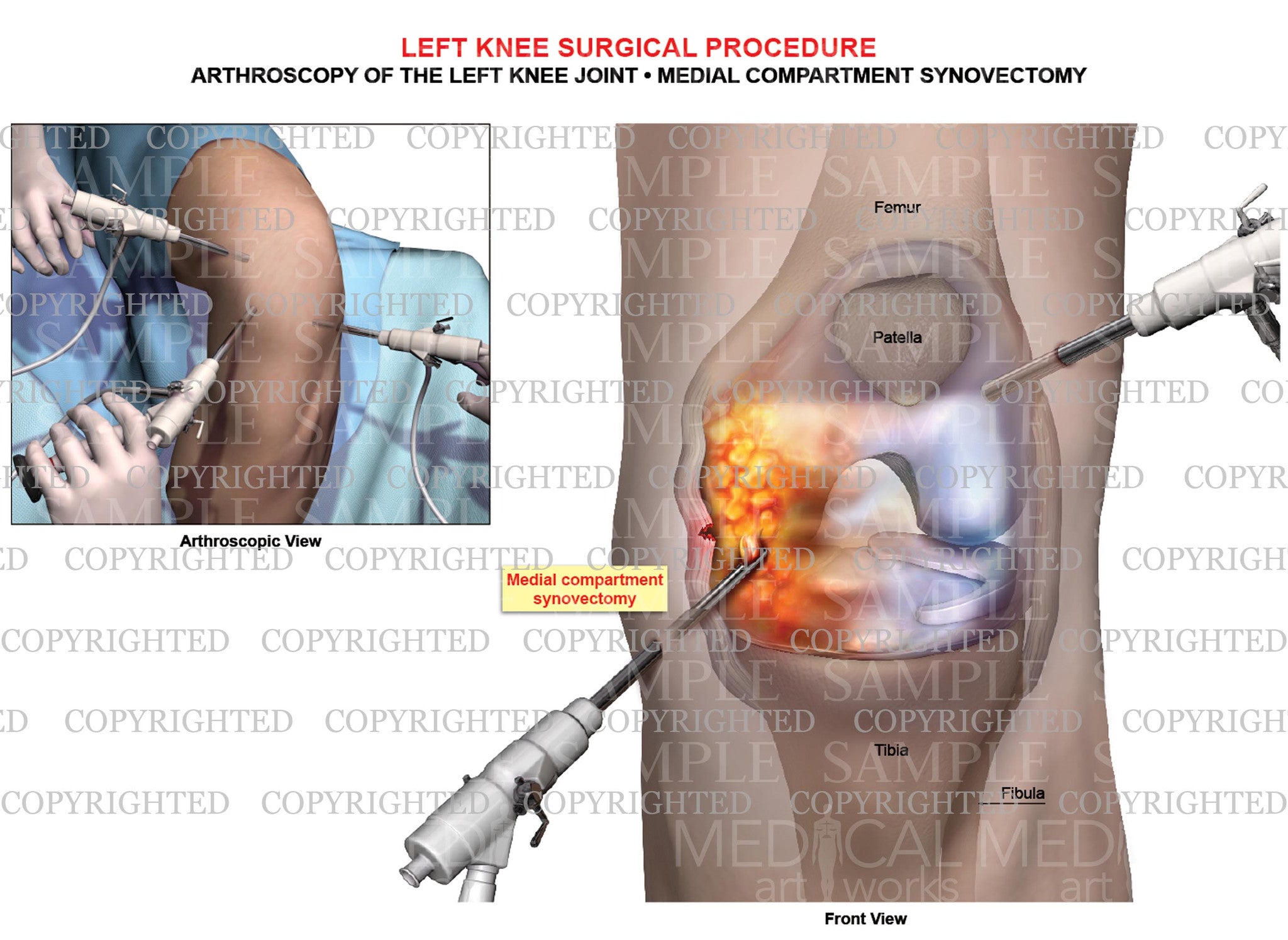 Arthroscopy of left knee joint Medial synovectomy Medical Art Works
