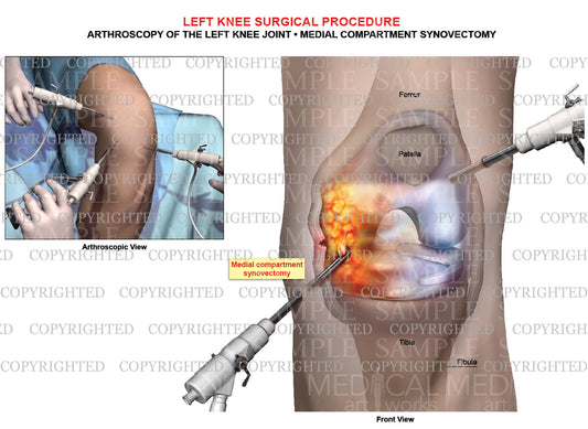Arthroscopy of left knee joint - Medial synovectomy