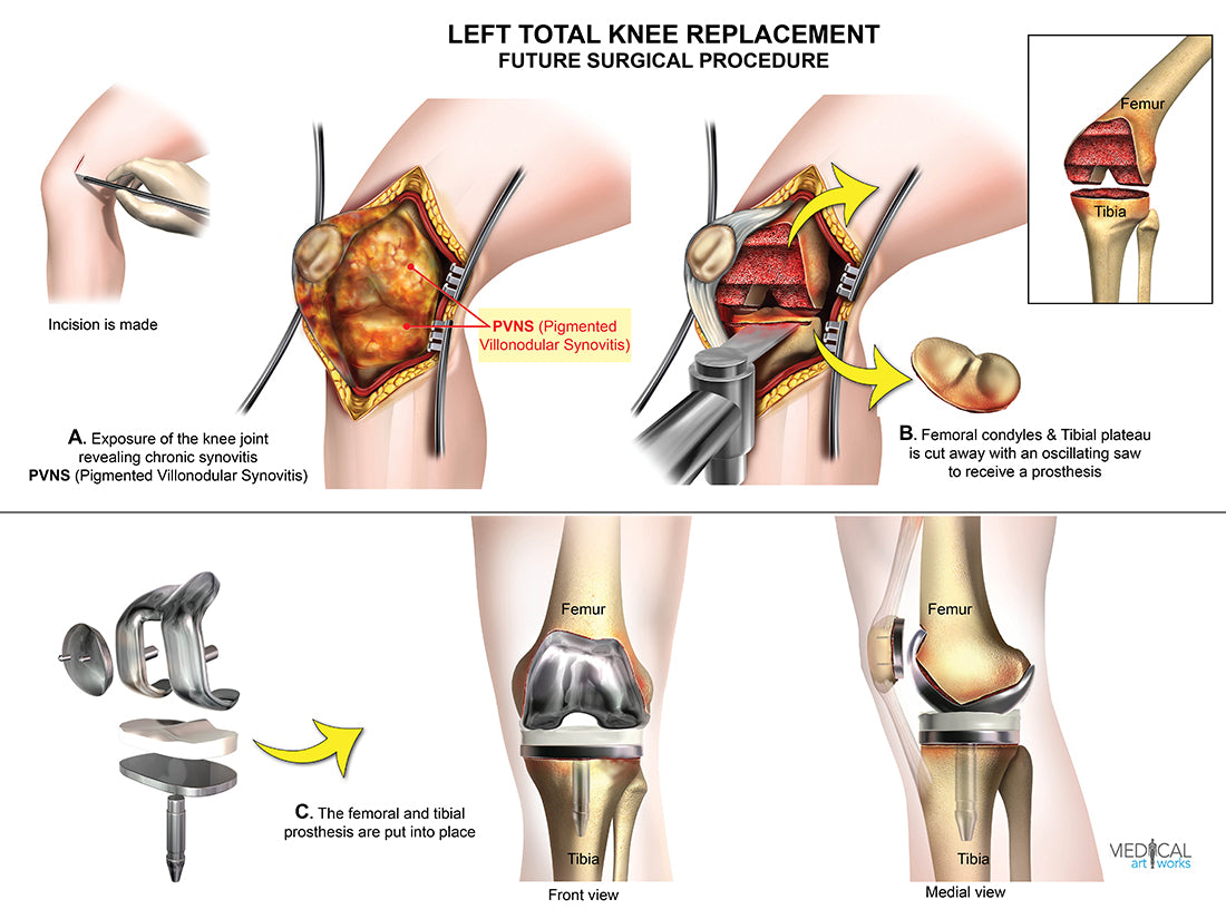 Total Left Knee Replacement - PVNS (Pigmented villonodular synovitis)