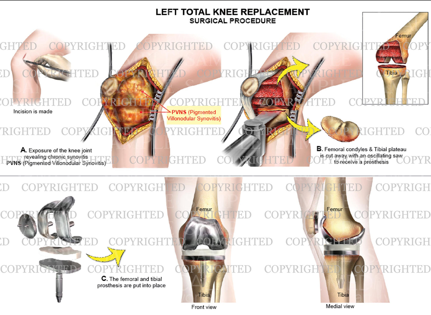 Total Left Knee Replacement - PVNS (Pigmented villonodular synovitis)