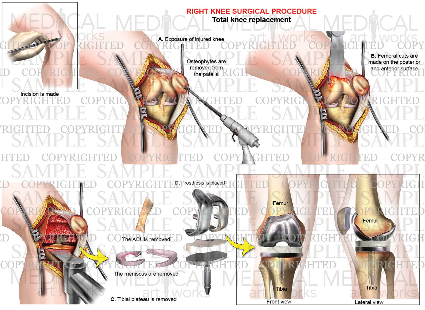 Right Knee Total Knee Replacement - ACL removed