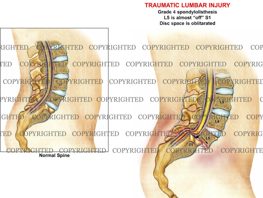 Lumbar Injury Condition Sagittal view