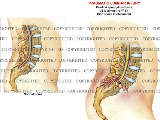 Lumbar Injury Condition Sagittal view
