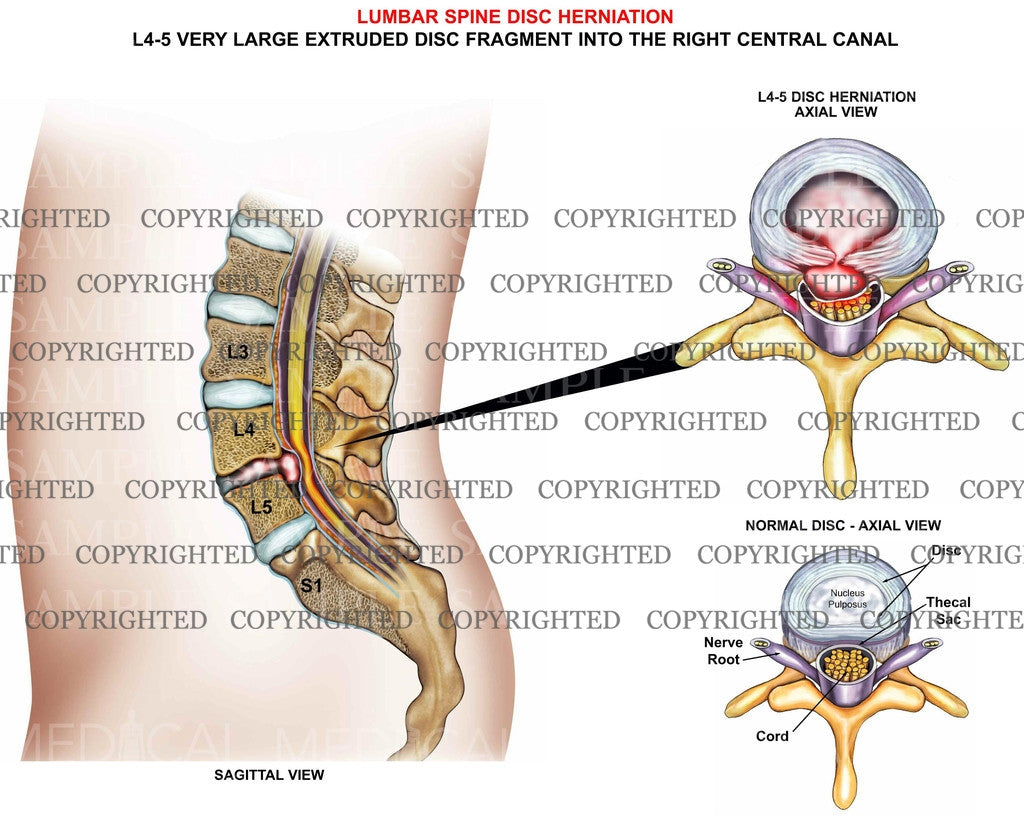 L4-5 Lumbar Spine Disc Herniation