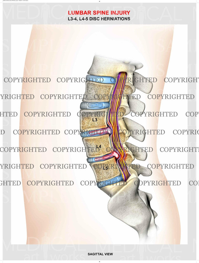 L3-4, L4-5 - Lumbar Spine herniations