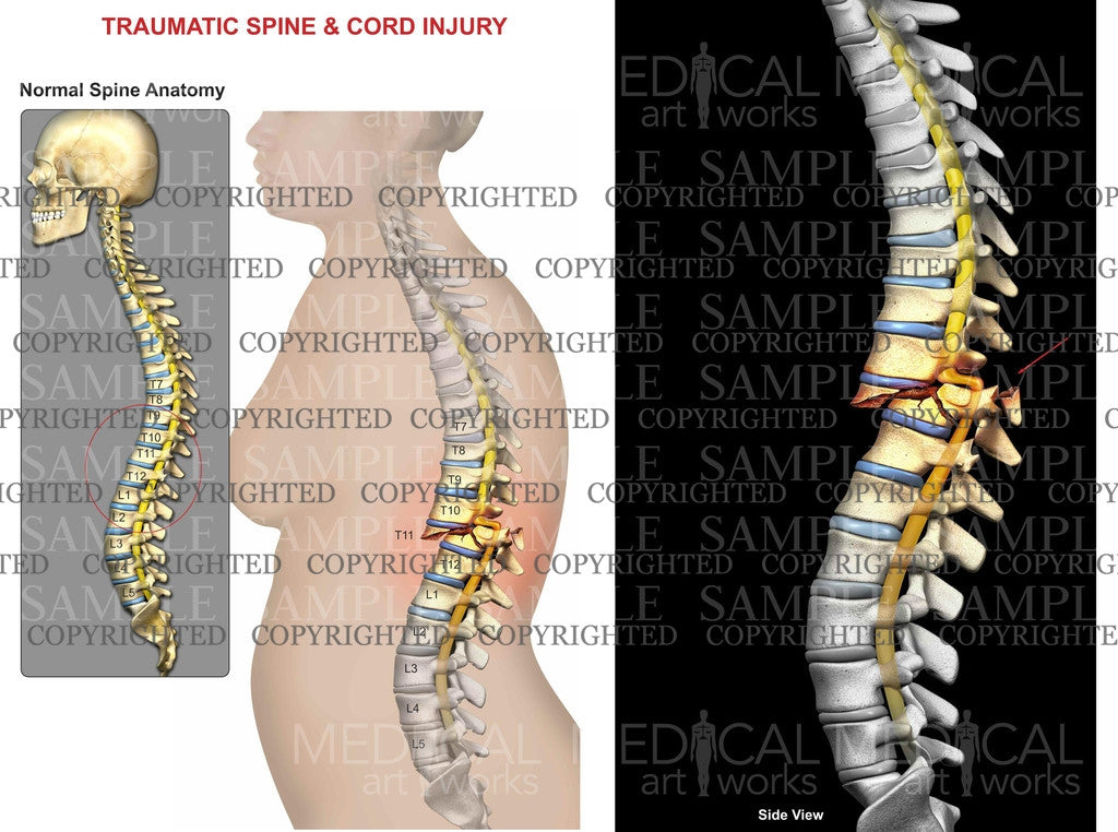 Traumatic Spine and Cord Injury