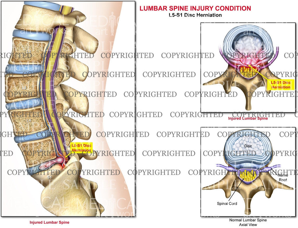 L5-S1 - Lumbar Spine Herniation