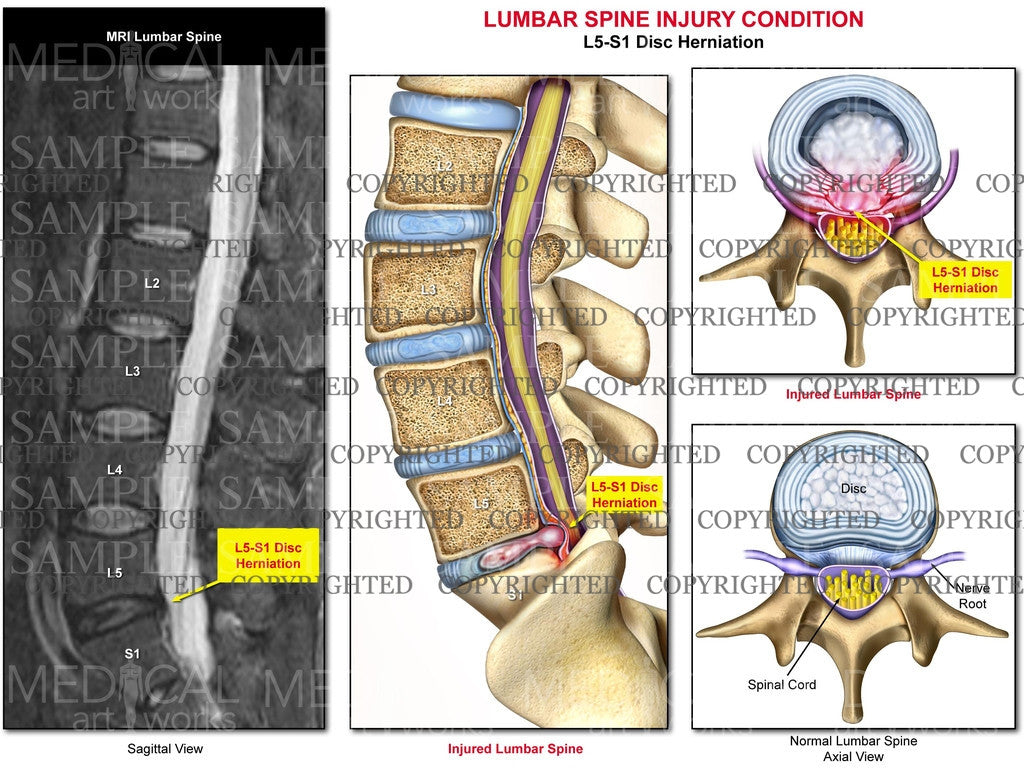 L5-S1 - Lumbar spine disc herniation with MRI