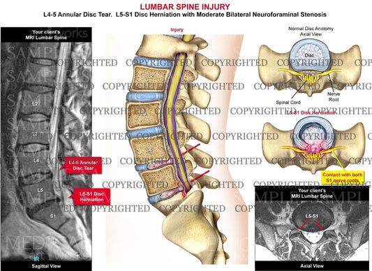 Lumbar Spine Injury 2