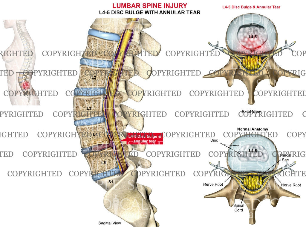 L4-5 Disc bulge