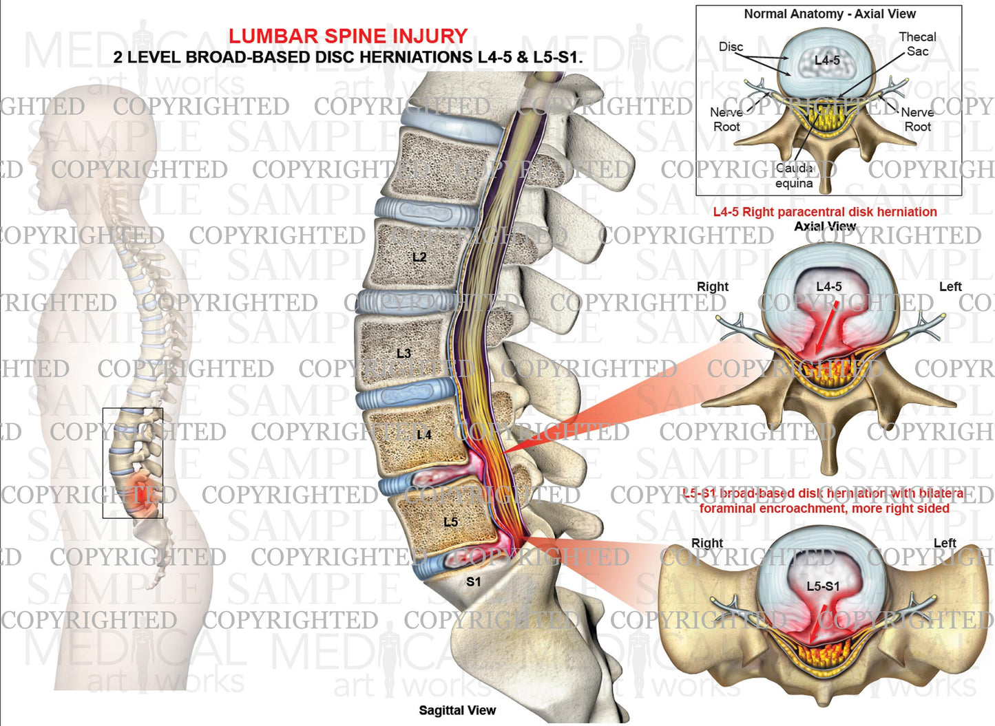 Lumbar Disc Herniations - Level 2 - L4-5