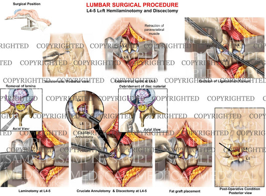 Lumbar hemilaminotomy surgery 2