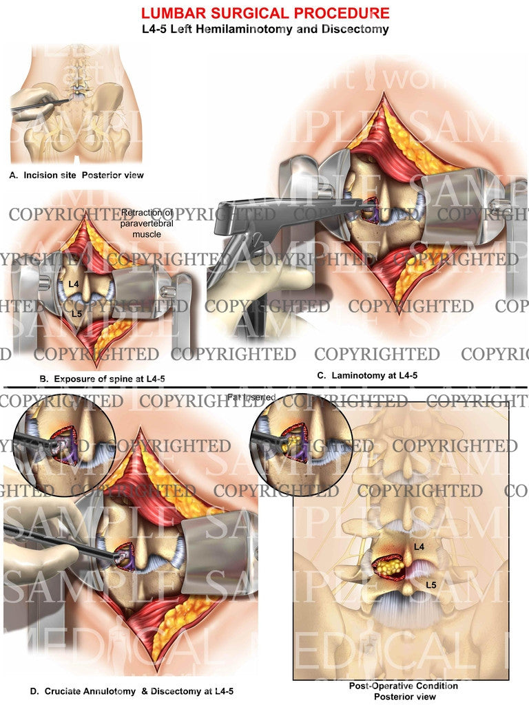 Lumbar hemilaminotomy surgery