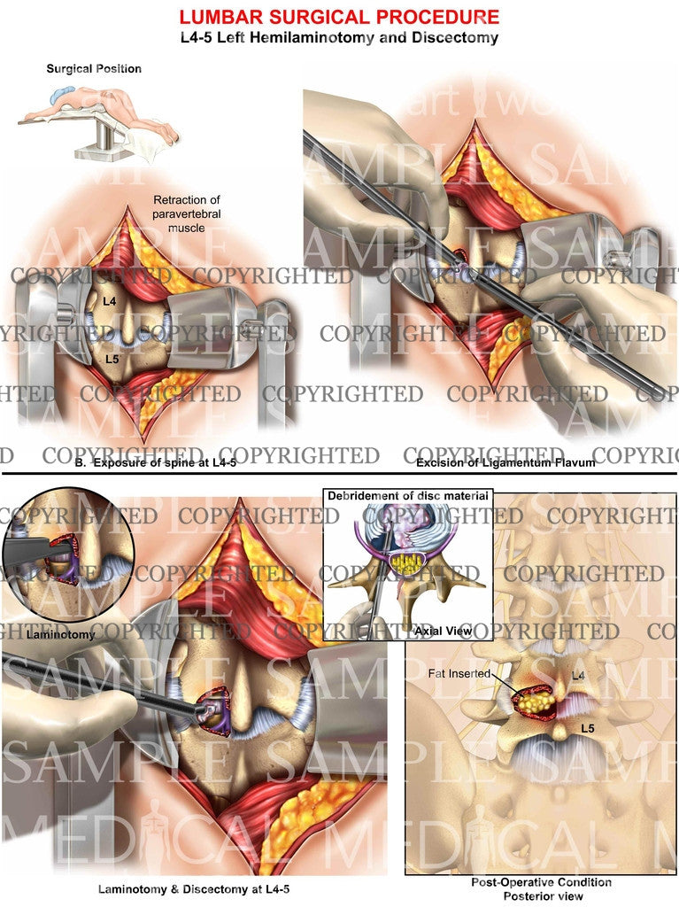 Lumbar hemilaminotomy surgery 3