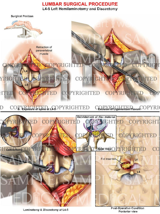 Lumbar hemilaminotomy surgery 3