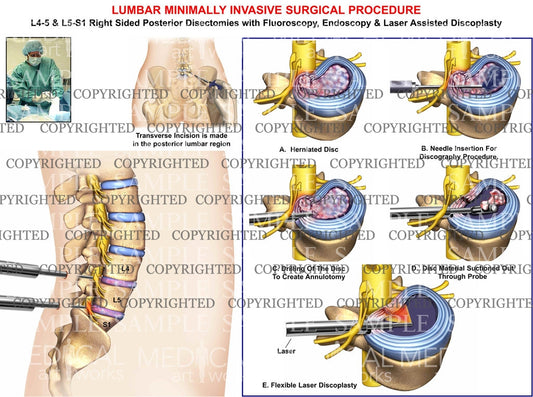 L4-5 & L5-S1 Lumbar spine minimally invasive fluoroscopy procedure