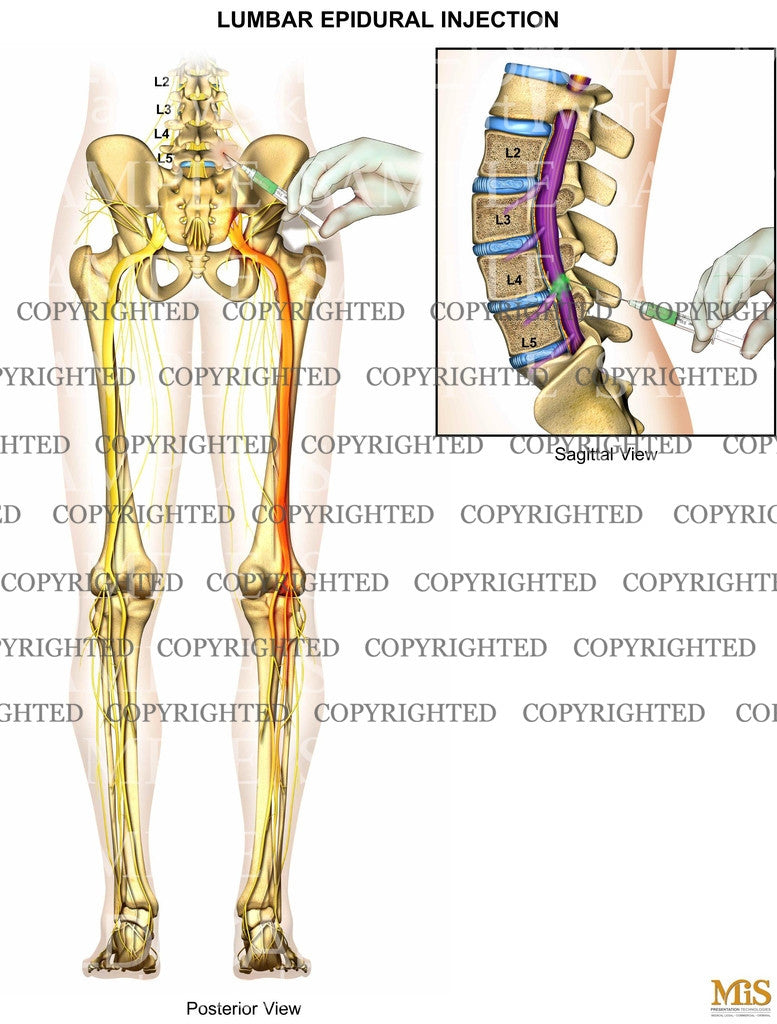 1 Level - L4-5 Lumbar epidural injection