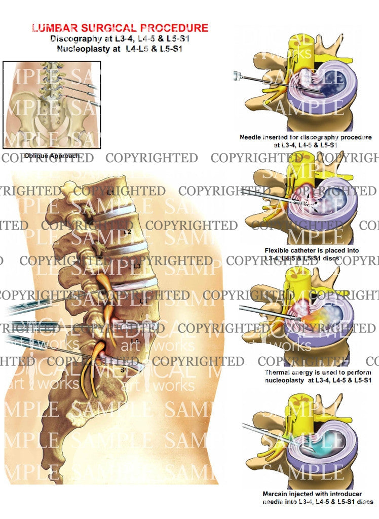 3 levels - Minimally invasive lumbar surgical procedure