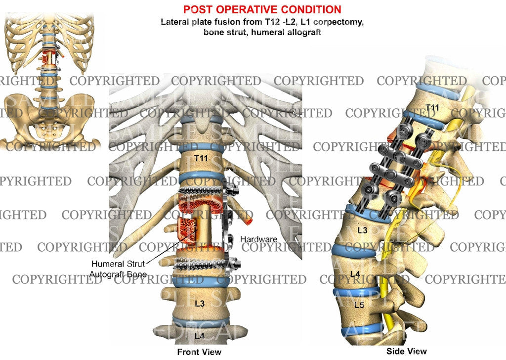 Post operative condition of T12-L2 Vertebral arthrodesis