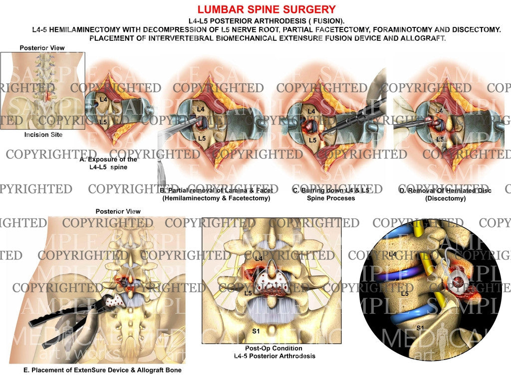 L4-5 Posterior arthrodesis