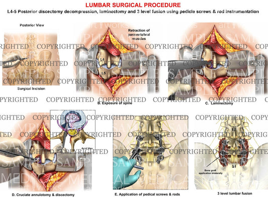 Lumbar posterior surgery