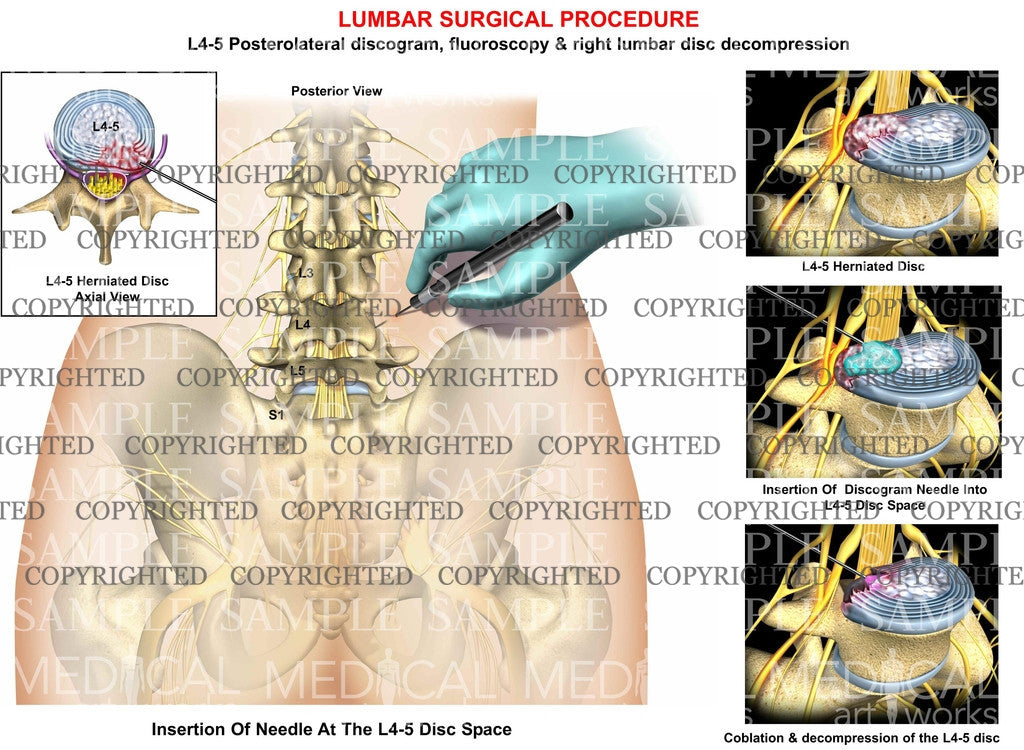 Lumbar posterolateral discogram