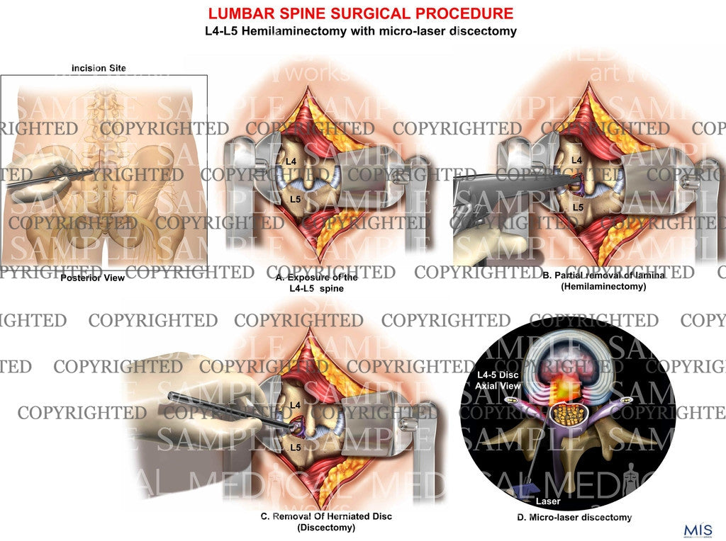 Lumbar surgery hemilaminectomy