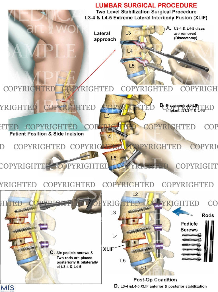 Two Level Lumbar Stabilization